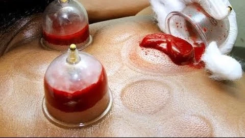 What is Hijama? A Comprehensive Guide to Cupping Therapy