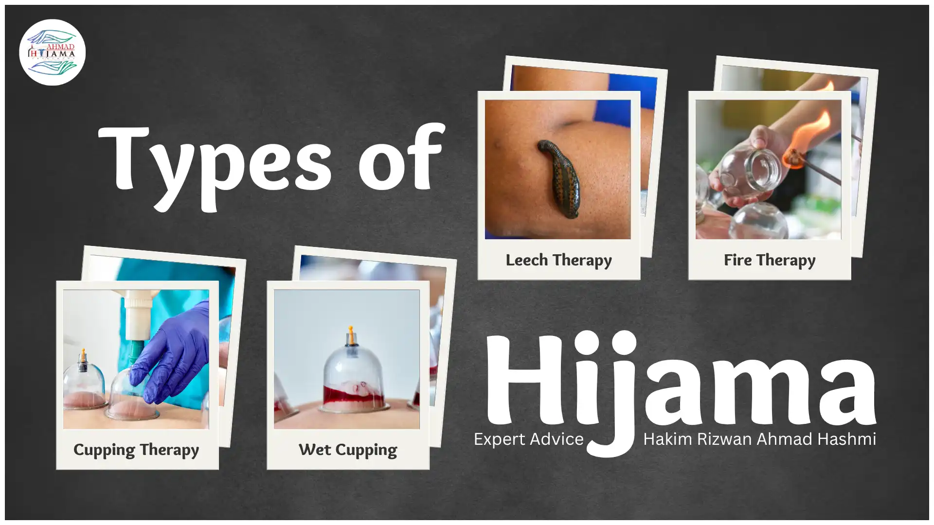 Types of Hijama Wet, Dry, Leech, and Fire Therapy Explained