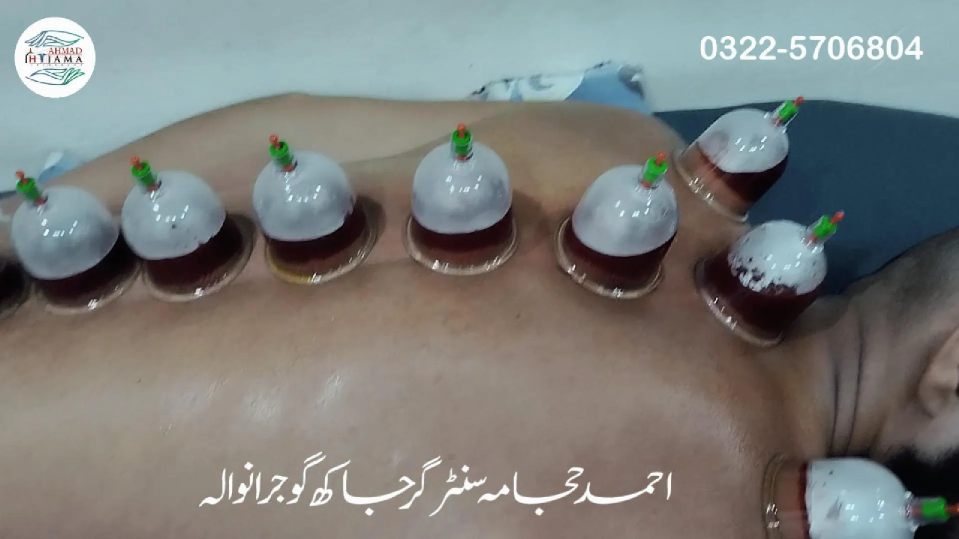 umar patient hijama interview at Ahmad Hijama Center and Cupping Therapy